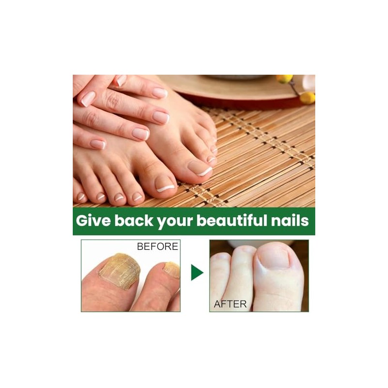 Ginger Nail, Tratamiento de Uñas con Jengibre, Soporte para Uñas,
