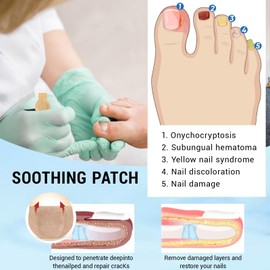 Xumann 8 Hours Fungal Nail Patches, 21 Pcs Multi Purpose Nail Repair Patches for Toenails