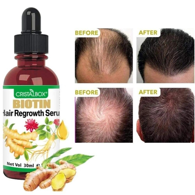 Evitar La Caida Del Cabello Aceite Biotina Para Ayudar Evitar