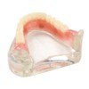 Dental Model Overdenture Inferior 4 Implants Demo Mandibular Model for