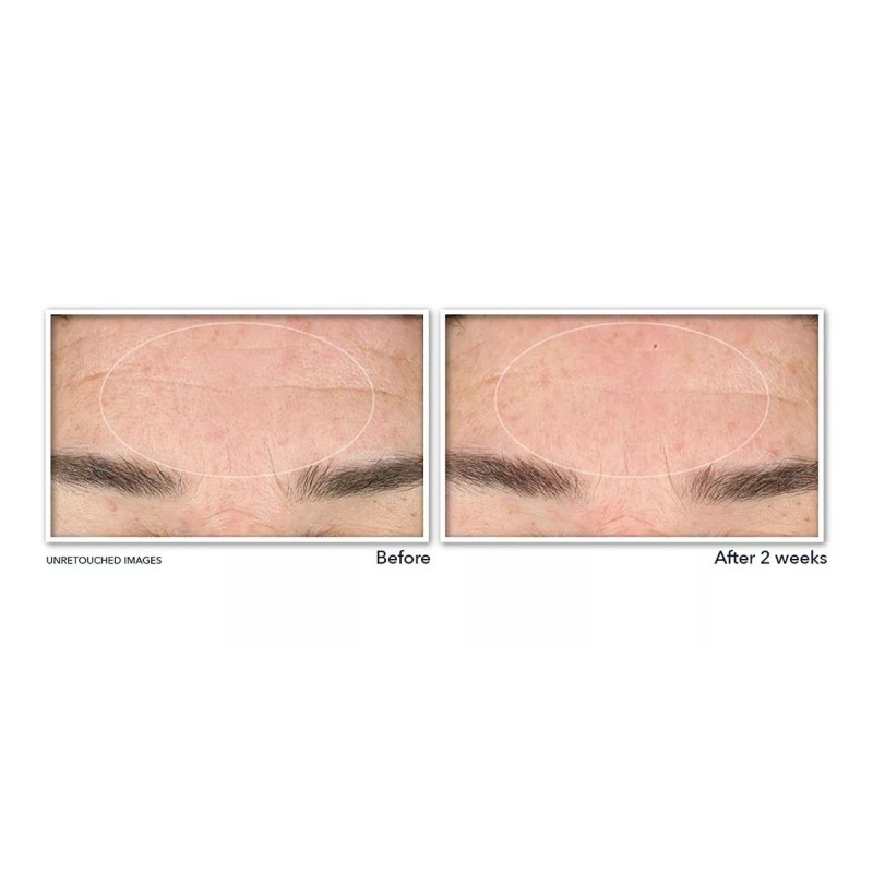 Roc Retinol Correxion-limpiador Facial De Suero De Arrugas