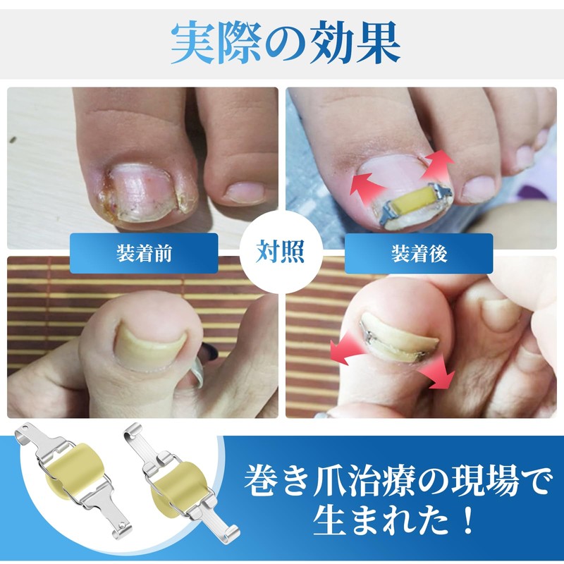 巻き爪器具 2個入り 巻き爪 まきづめ 陥入爪 まきずめ 巻爪 器具 オリジナル説明書付属 (16-18mm)