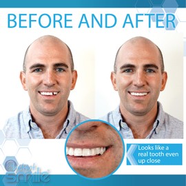 Instant Smile Complete Your Smile Temporary Tooth Replacement Kit with Extra Fitting Material