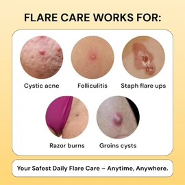 Thyme & Tea Tree Flare Care | Solution for Painful Pimples, Cystic Acne, Ingrowns, Folliculitis, Groin Flare Ups, Razor Bumps | Bartholin | Safe Flare-Up Solution with Egg Yolk Extract & Tea Tree 1 oz