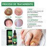 Líquido Para Hongos En Las Uñas-tratamiento Para Uñas