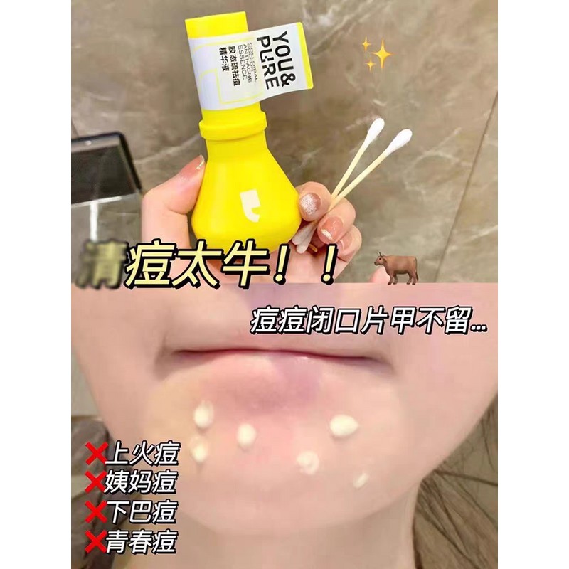 大灯泡胶态硫祛痘精华液急救祛痘膏痘坑痘印粉刺闭口 Large Bulb Gel Sulfur Acne Removal Essence First Aid