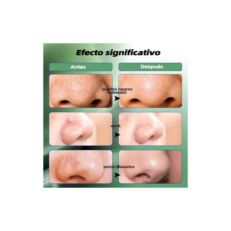 150 Tiras Elimina Puntos Negros Nariz de Carbon Activado Peel