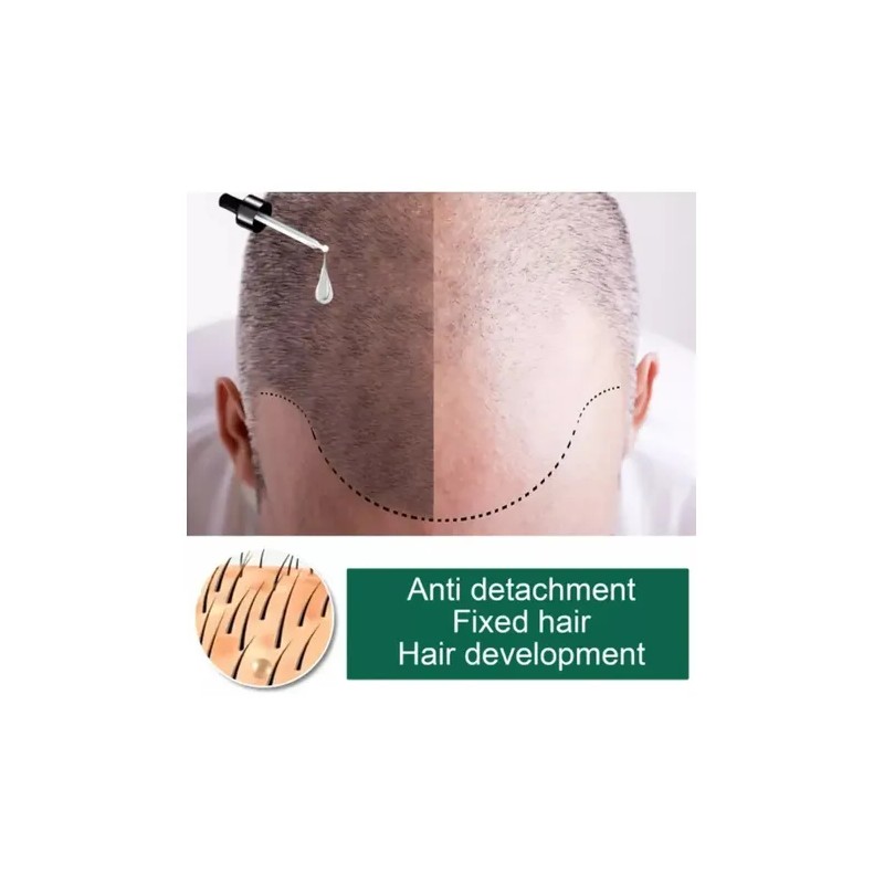 Tratamiento Regenerativo Cabello Calvicie Caida Natural 30ml
