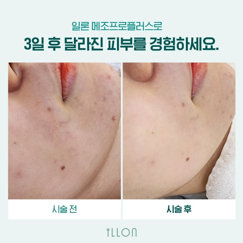 theory Elon Mesopro 2.5g fine needle peeling + mask +