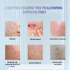 No Brand Real and effective Acne Pimple Cream 祛痘膏祛痘乳霜 20g