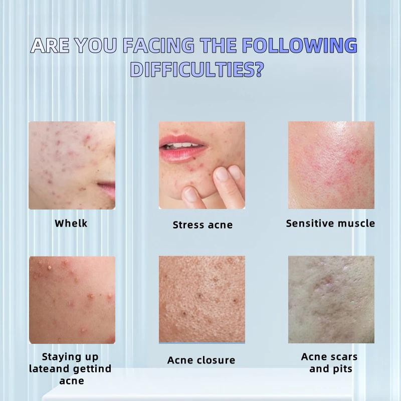 No Brand Real and effective Acne Pimple Cream 祛痘膏祛痘乳霜 20g