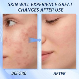 Acne Foaming Cleanser,Gentle Hydrating Foaming Cleanser with Hyaluronic Acid, Fragrance-Free Face Wash for Sensitive, Oily & Dry Skin, Improve The Appearance of Acne-prone Skin