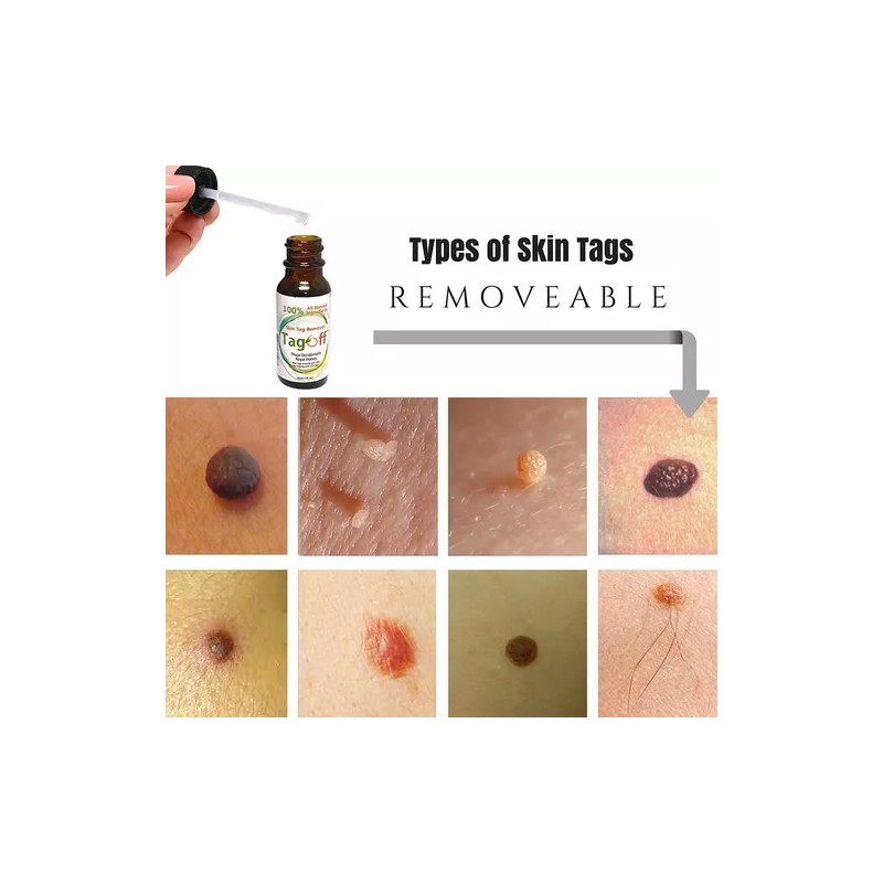 Tagoff Remueve Naturalmente Verrugas Sin Dolor Ni Cicatrices