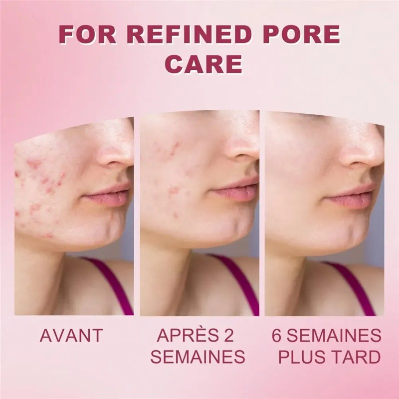 Sérum De Ácido Azelaico 20 G, Reduce Las Imperfecciones
