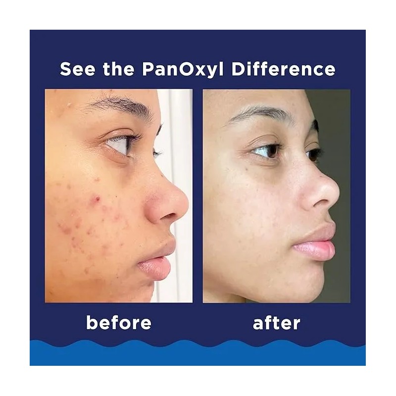 Panoxyl Acné Foaming Wash 10% Peróxido De Benzoilo 156 G