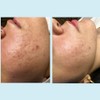 Salicylic Acid 20% Gel Peel - Enhanced with Tea Tree