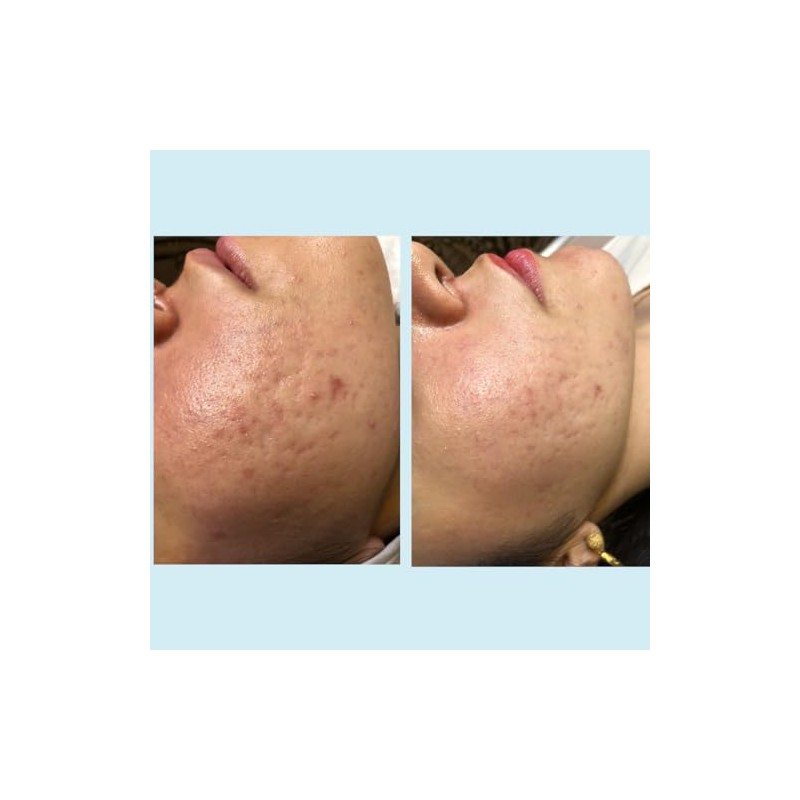 Salicylic Acid 20% Gel Peel - Enhanced with Tea Tree