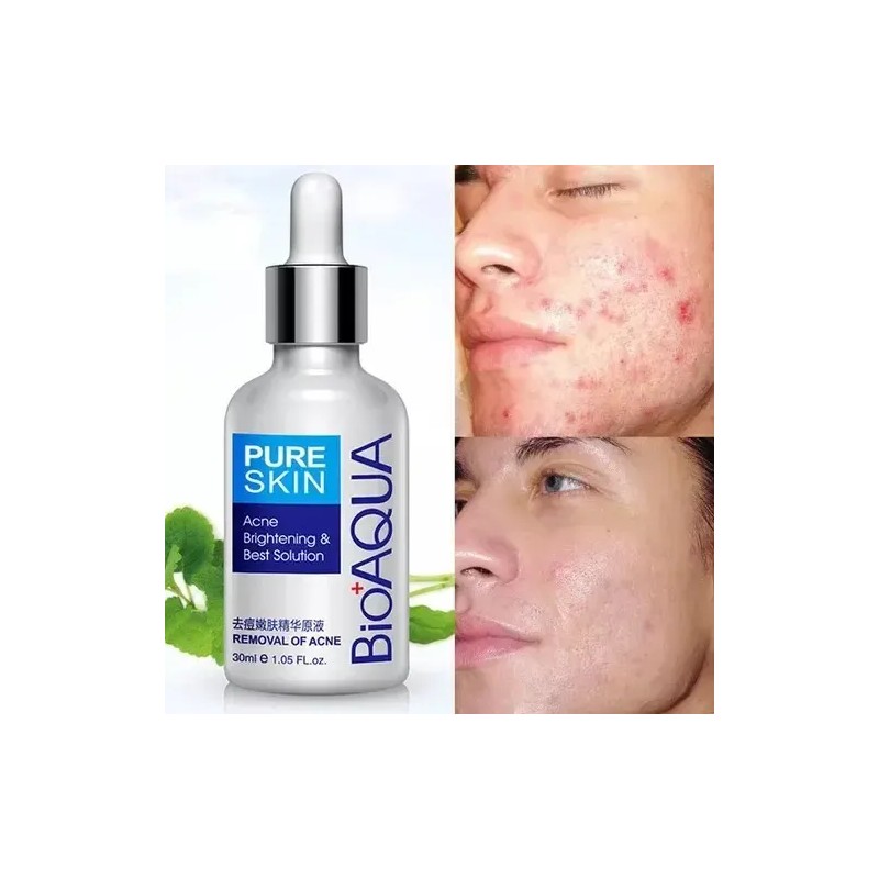 Tratamiento Acne Puntos Negros Manchas Cicatrices Barros 2pz