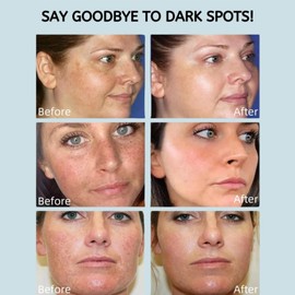 Dark Spot Correcting Serum For Face Hydrating With 5% Niacinamide,Dark Spot Correcting Niacinamide,Brightening Serum For Korean Skincare Uneven Skin Tone,Improve Dull Skin,Fades Blemish(50ml)