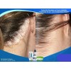 Crema Más Suave, Pepepsor Y Shampoo Para Psoriasis
