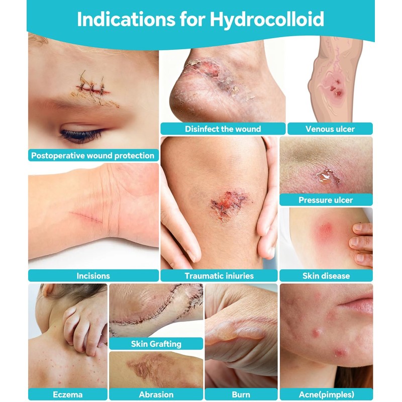 2026 Upgrade Hydrocolloid Roll for Wound Care, 2in*16.4ft Cuttable Hydrocolloid