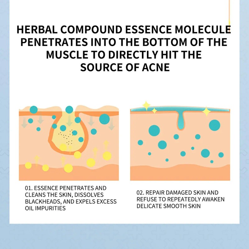 Gel Retinoide Tópico Para El Tratamiento Del Acné