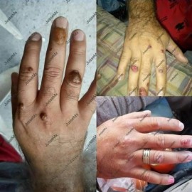 Aceite Jusse Quita Verrugas Mesquinos Lunares Bulto Planos