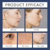 Crema Facial , Crema Removedora De Arrugas Qinglin Pa