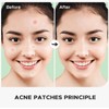 Vivid Acne Patches - Pack of 36 Translucent Hydrocolloid Pimple