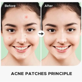 Vivid Acne Patches - Pack of 36 Translucent Hydrocolloid Pimple Patch Spot Treatment Stickers (No smell) for Face and Body- Fast-Acting, Vegan & Cruelty Free Skin Care