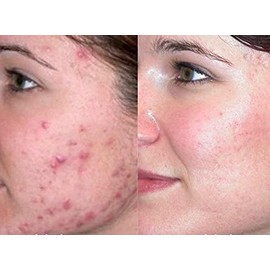 TODAYS OFFER - Best Skin Tightening Vitamin C Serum for Acne Prone Skin, Age  Dark Spot and Blemish for Men  Women that Want Clear and Fresh Skin...  