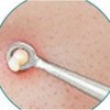 뾰루지짜기 등드름압출 초등학생코피지 볼블랙헤드 턱화이트헤드 Pimple Squeezing Back Acne Extraction