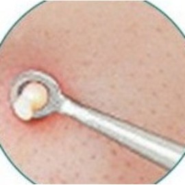 뾰루지짜기 등드름압출 초등학생코피지 볼블랙헤드 턱화이트헤드 Pimple Squeezing Back Acne Extraction for Elementary School Students, Nose Blackheads, Chin Whiteheads