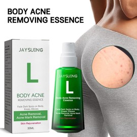 Pimple Spot Serums | Body Acnes Repair Essence - 30ml Acnes Removing Essence, Shrink Skin Pores Face Essence, Body Beauty Products - Hydrating Body Skin Fade Dark Spots On Body Zonewd