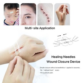 MEMNUN Wundverschlussgerät, Notfall-Wundreparatur, keine chirurgische Naht erforderlich, Familien-Backup, Outdoor-Sport, Camping-Essential (5 Stück)