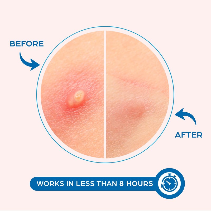 KEYCONCEPTS Pimple Patches for Face (240 Patches), Hydrocolloid Acne Patches