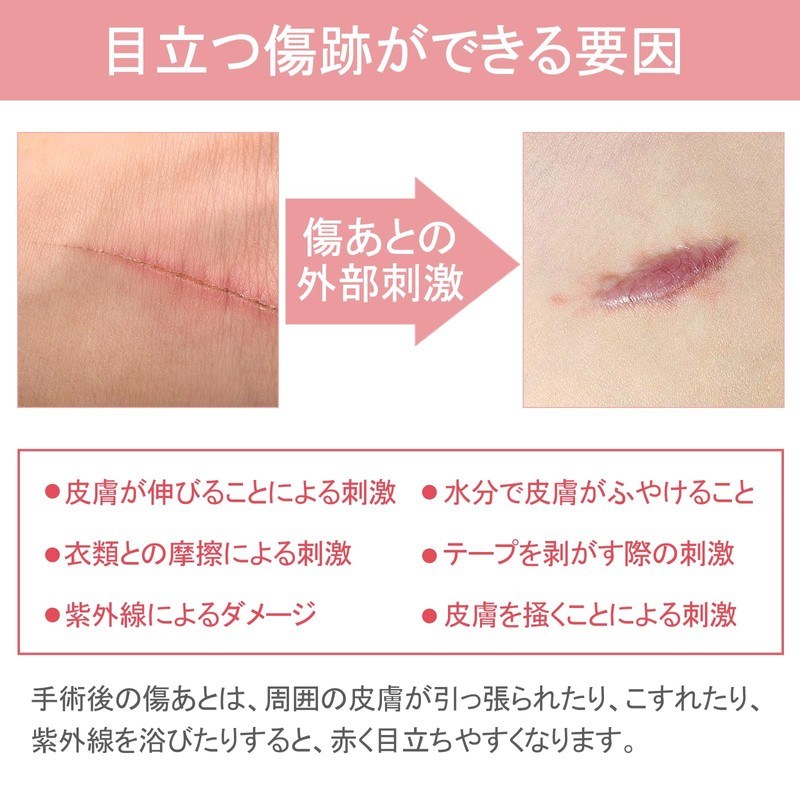 傷跡ケアテープ ケロイド テープ 傷あとケア用シリコンジェルシート 手術後 帝王切開 傷テープ 傷隠しテープ