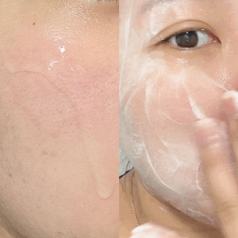Acleon Anasis Mildly Alkaline Cleansing Foam Acne Treatment 2 Types