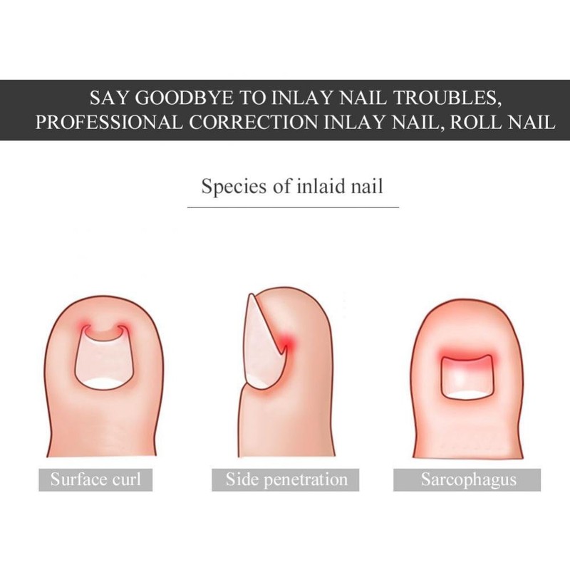 Nail Corrector Pedicure ment Foot Care Tool, 12Pcs/Box Toenail Correction