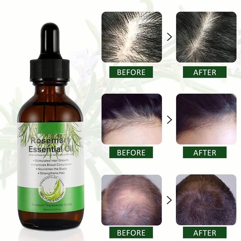 Pelo Aceite De Romero Para El Crecimiento Del Cabello, Suero