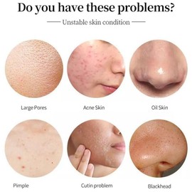 ARCHIDATE Salicylic Acid Serum 5% for Acne, Deep Cleans Pores, Reduce Blackheads, Controls Oil, Gentle Exfoliation, Lightweight, Fast-Absorbing, Salicylic Acid Face Serum for Oily Acne Prone Skin