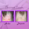 Crema Facial & Corporal Psoriasis Cream Hidratante Aliviante
