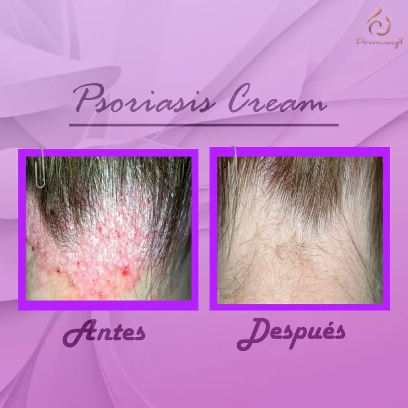Crema Facial & Corporal Psoriasis Cream Hidratante Aliviante