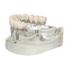 Ningfan Dental Implant Model,Implant All on 4 Overdenture Treatment Model,