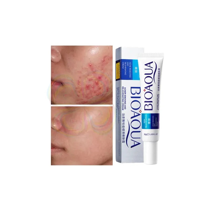 Crema Cicatrices Poros Control De Grasa Acne Cream 2pz Full