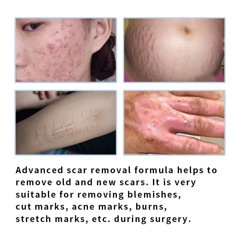 Crema Reduce Cicatriz Queloide Promueve Regeneracion Celular Neutral