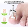 Ingrown Toenail Fixer, Adjustable Toenail Paronychia Corrector, Pedicure Care Tool