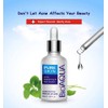 BIOAQUA Face Acne Treatment Scar Removal Spots Pimples Moisturizing Essential