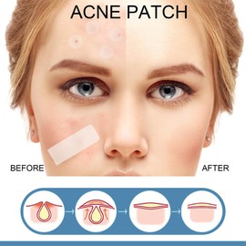 WUSJCOF 156 Stück Große Akne Patches für Gesicht, Kinn, Rücken oder Körper, Hydrokolloid Akne Patches für alle Hauttypen (5 Größen)