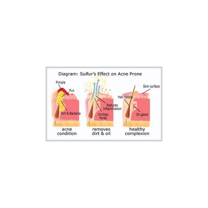 Sulfur Soap - Medical Grade OTC Dermatologists Approved 40 yrs